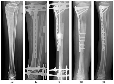 Jcm Free Full Text Tibial Lengthening Along Submuscular Plate With