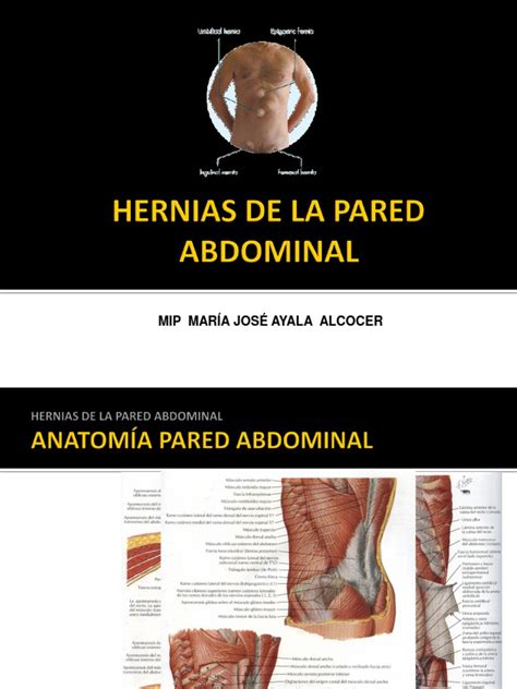 Hernias De La Pared Abdominalppt Abdomen Enfermedades Y Trastornos