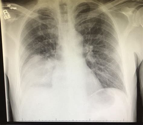 Legionella Pneumonia Associated With Tumor Necrosis Factor Inhibition