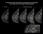 3-D mammography improves cancer detection in | EurekAlert!