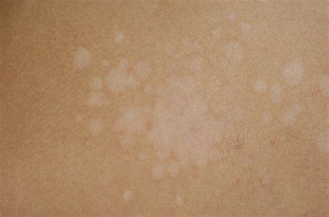 Pityriasis Versicolor Of The Skin Bild Kaufen 11568651 Science