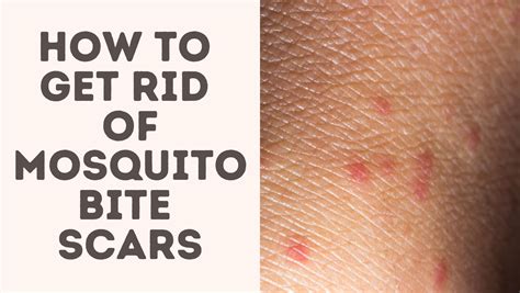 How To Get Rid Of Mosquito Bite Scars Treat Your Scars