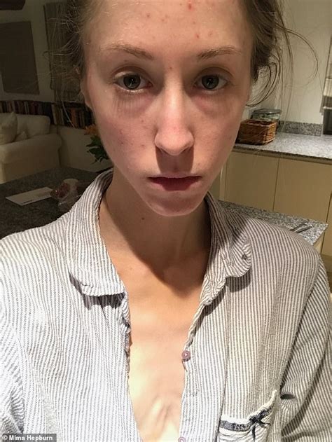 Anorexia Survivor Shares Her Diary Of Daily Battle During Treatment At An Eating Disorder