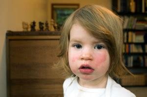 Slapped Cheek Syndrome Pictures Symptoms Treatment Causes