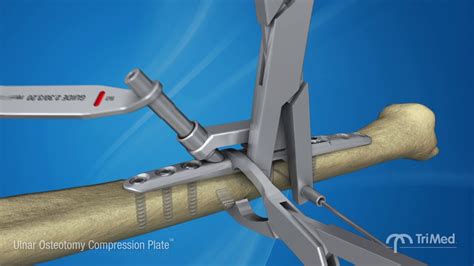 Ulnar Osteotomy Compression Plate Surgical Animation Youtube