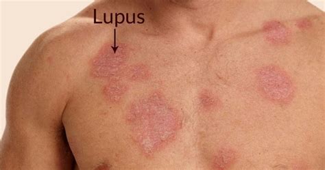 Lupus Symptoms 13 Ways To Spot Lupus Disease Early The Planet Today