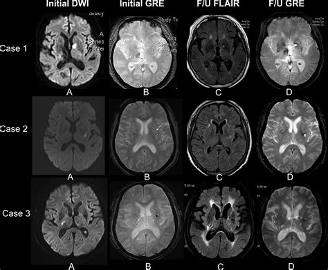 Hemorrhagic Focus Within The Recent Small Subcortical Infarcts On Long