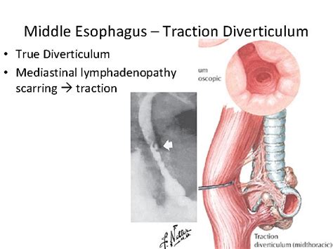 Diverticula Of The Alimentary Tract Aaron Sinclair Md