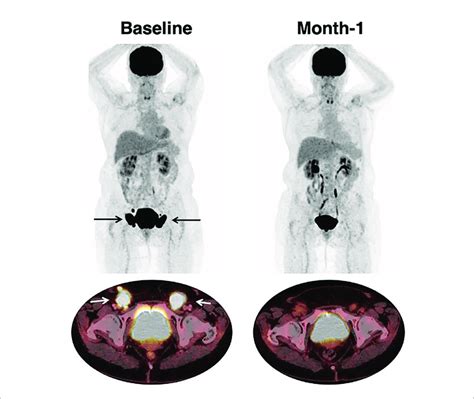 Response To Car T Cell Therapy 66 Year Old Patient With Past Medical