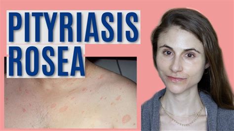 Pityriasis Rosea What It Is And Getting Rid Of It Dr Dray Youtube