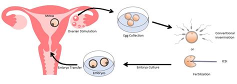 In Vitro Fertilization