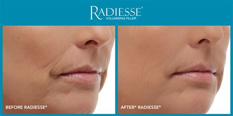 Fill In Plump Up And Rejuvenate Radiesse Has The Answer