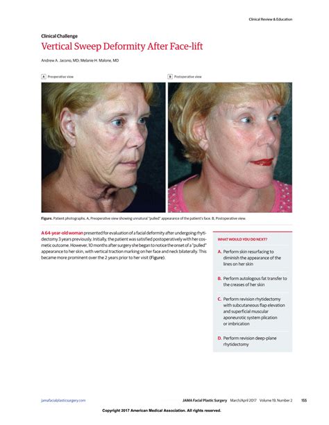 Vertical Sweep Deformity After Face Lift Brow Face Forehead Lift Jama Facial Plastic