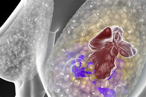 El Blog De Ceess Un “microentorno” En Las Células De Cáncer De Mama