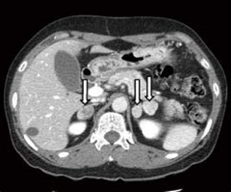 Adrenal Computed Tomography Ct Axial Images From Download