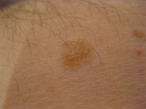 Rough Skin Patch On Chest Lasopalatin