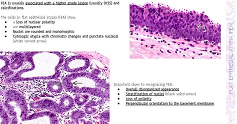 High Yield Breast Pathology Fibrocystic Changes Breast Tumor Breast