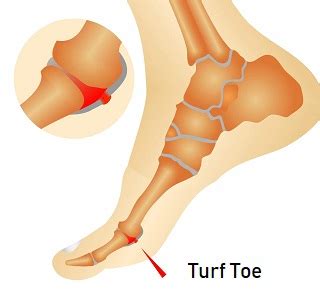 They usually occur after an acute injury although repetitive forced upward movement of the great toe may also lead to an injury of the tissue. Turf Toe Injury: Causes, Diagnosis & Treatment - Foot Pain Exp