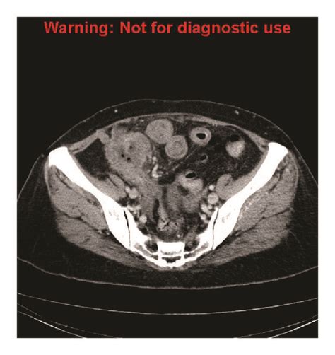 A Persistent Periappendiceal Collection Is Again Seen New Findings