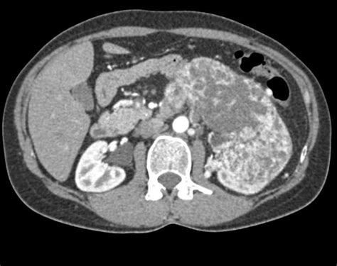 Renal Cell Carcinoma Kidney Case Studies Ctisus Ct Scanning