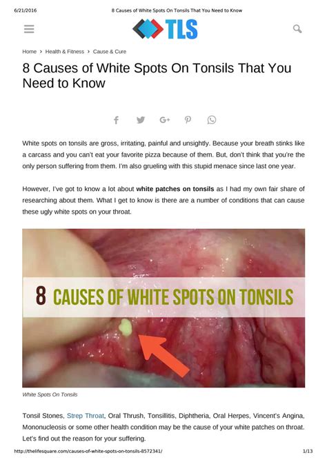 8 Causes Of White Spots On Tonsils You May Not Know By The Life Square