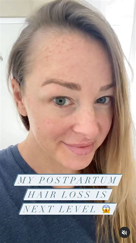 Jamie Otis Shows Off Her Bald Spots Due To Postpartum Hair Loss