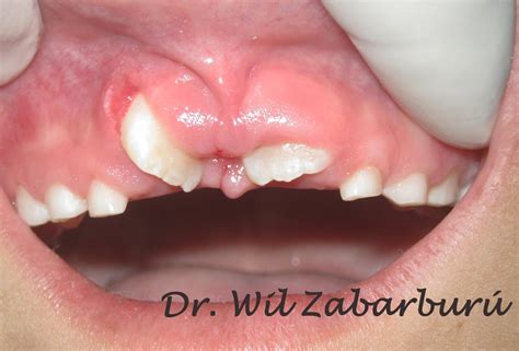 They can be well formed or just little clumps of. CLINICA DENTAL ASISTENCIAL: MESIODENS RETENIDO, TRATAMIENTO