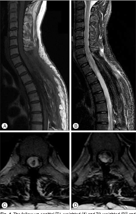 Figure 4 From Spontaneous Spinal Subdural Hematoma With Simultaneous