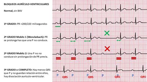 Como Leer Un Electrocardiograma Electrocardiograma Ap Vrogue Co