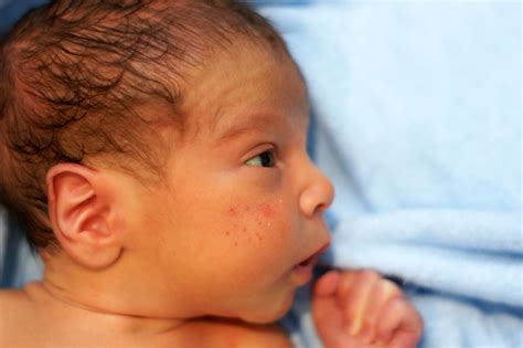 Understanding Common Infant Skin Conditions
