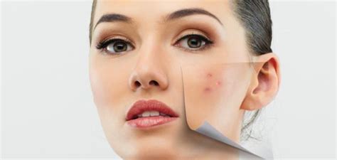 Acne Treatment For Oily Skin Naturally Health 1time Health And
