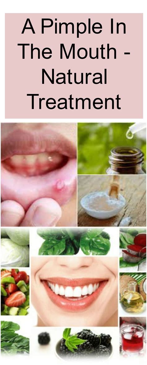 A Pimple In The Mouth Natural Treatment Healthy Tips Natural