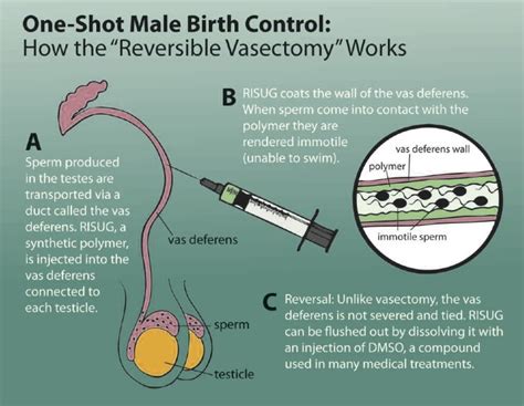 reversible vasectomy the tenpenny report