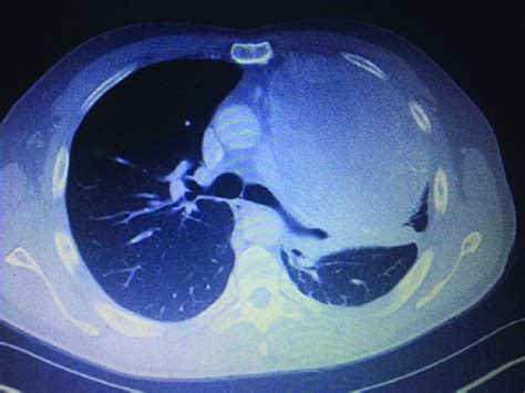 Ct Chest Showing Well Delineated Mass With Mediastinal Shift