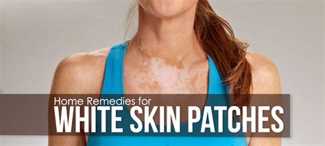 How To Get Rid Of Skin Patches Natural Way To Remove White Patches