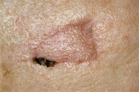 Scar On The Skin After Cancer Removal Stock Image C0085774