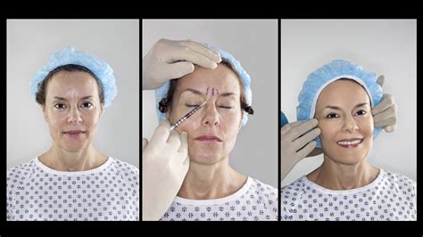 How Effective Is Botox In Removing Wrinkles