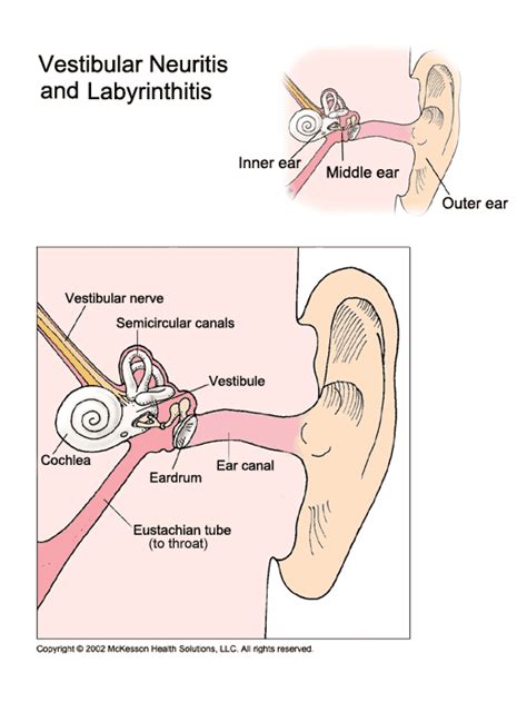 Vestibular Labyrinthitis Causes