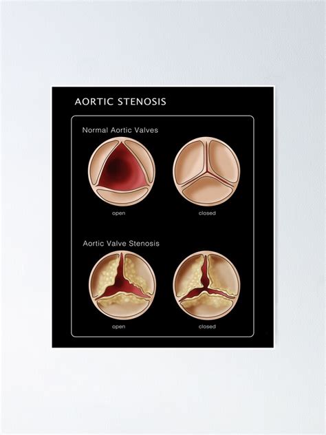 Medical Illustration Of Heart Valves Normal And Stenosis Poster For