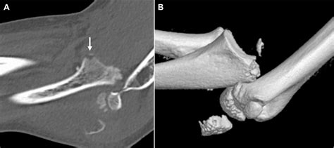 Figure 2 From Anterior Transolecranon Fracture Dislocation With An