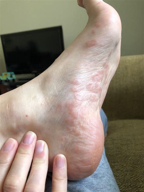 Itchy Bumps On Feet BabyCenter