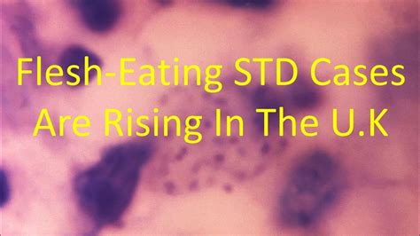 Rare Flesh Eating Std Cases Are On The Rise In The Uk Youtube