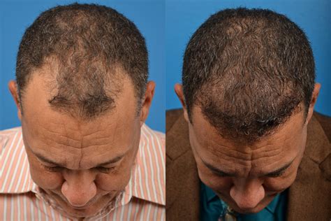 Hair Restoration Photos Melbourne FL Patient 57493