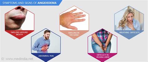 Angioedema Causes Symptoms Diagnosis And Treatment