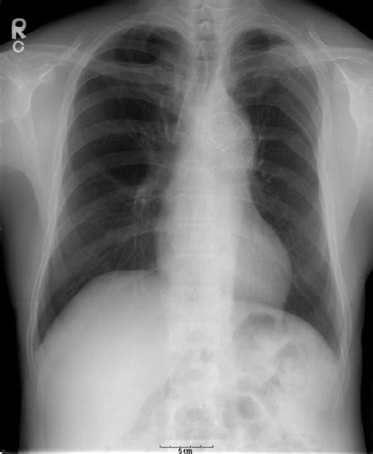 Chest Radiograph Showed A Stent In The Aortic Arch And No Specific