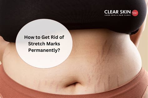 How To Get Rid Of Stretch Marks Permanently