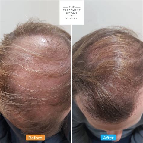 Crown Hair Transplant The Treatment Rooms London