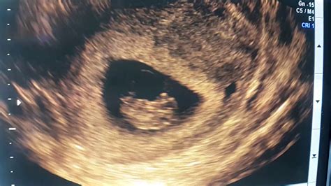 First Trimester Ultrasound Scan Subchorionic Separation Youtube