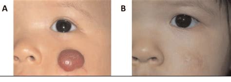 Figure 1 From Treatment Of Infantile Hemangioma By Intralesional