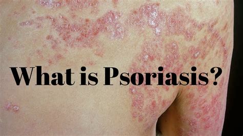 What Is Psoriasis Symptoms Causes सोराइसिस दाद एक्जिमा के नुस्खे